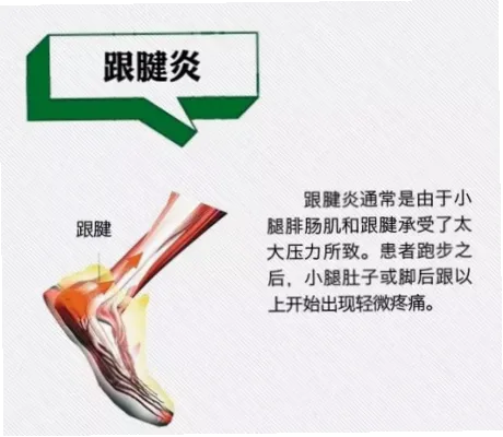 跑步跟腱炎恢复是许多跑者的痛点，但通过科学分阶段管理